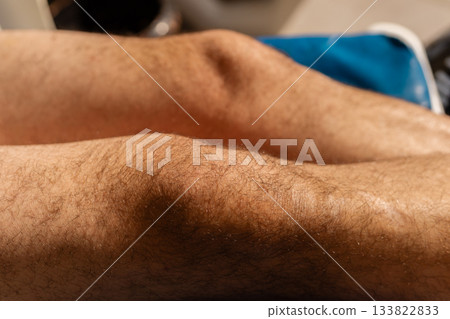 Close-up view of legs undergoing hair removal, highlighting the skin texture and hair follicles. The setting suggests a beauty or spa environment, focusing on hair care Close-up view of legs undergoing hair removal, highlighting the skin texture and hair follicles. The setting suggests a beauty or spa environment, focusing on hair care 133822833