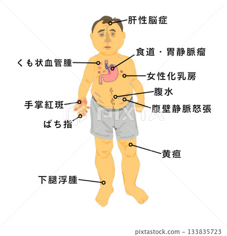肝硬化全身症狀圖示：黃疸、腹水、蜘蛛痣等護理學生醫學教育資料 133835723
