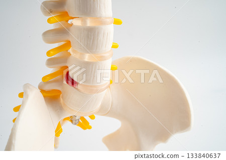 Lumbar spine displaced herniated disc fragment, spinal nerve and bone. Model for treatment medical in the orthopedic department. Lumbar spine displaced herniated disc fragment, spinal nerve and bone. Model for treatment medical in the orthopedic department. 133840637