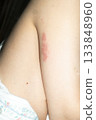 Woman with shingles on the skin she feels very painful 133848960