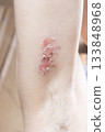 Woman with shingles on the skin she feels very painful 133848968