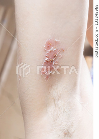 Woman with shingles on the skin she feels very painful 133848968