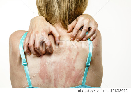 Woman scratching her itchy back with allergy rash 133858661