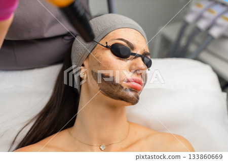 Carbon laser facial procedure in a beauty clinic with a woman wearing protective eye shields and a carbon mask during treatment. 133860669