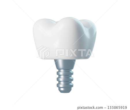 3D Dental Implant with Crown and Screw Post for healthy and orthodontics. 3d rendering 3D Dental Implant with Crown and Screw Post for healthy and orthodontics. 3d rendering 133865919