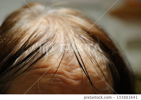 Serious hair thinning problems Gray hair 133881641