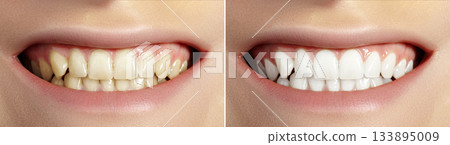 Woman Teeth Before and After Whitening. Perfect Smile with Healthy Teeth. Dental Clinic Patient. Oral Care Dentistry Woman Teeth Before and After Whitening. Perfect Smile with Healthy Teeth. Dental Clinic Patient. Oral Care Dentistry 133895009