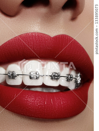 Beautiful white teeth with braces. Dental care photo. Woman smile with ortodontic accessories. Orthodontics treatment 133895073