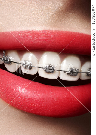 Beautiful white teeth with braces. Dental care photo. Woman smile with ortodontic accessories. Orthodontics treatment Beautiful white teeth with braces. Dental care photo. Woman smile with ortodontic accessories. Orthodontics treatment 133895074