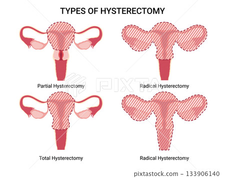 Hysterectomy, surgical removal of the uterus. Vector Medical illustration shows 4 types of hysterectomy: partial, total, radical types. Removal of fallopian tubes, ovary. 133906140