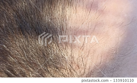 A close-up of hairline texture and growth patterns, highlighting sharp edges. Suitable for medical articles, personal care ads, and cosmetic visuals, focusing on natural detail. A close-up of hairline texture and growth patterns, highlighting sharp edges. Suitable for medical articles, personal care ads, and cosmetic visuals, focusing on natural detail. 133910110