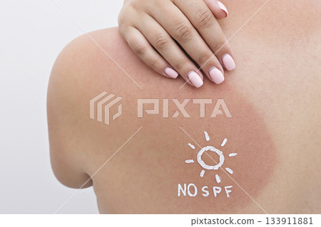 Closeup of red sunburn on shoulder with NO SPF sun symbol in cream, tender skin and UV exposure shown 133911881