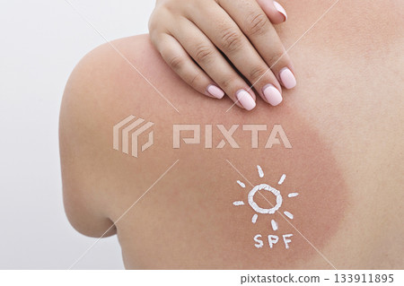 Closeup of red sunburn on female shoulder with SPF sun sign in cream, showing UV exposure and tender skin Closeup of red sunburn on female shoulder with SPF sun sign in cream, showing UV exposure and tender skin 133911895