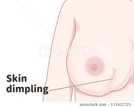 Breast cancer symptoms: dimples and tightness - easy-to-understand English illustrations Breast cancer symptoms: dimples and tightness - easy-to-understand English illustrations 133922725