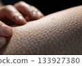 Skin Shows Goosebumps While a Hand Touches It During a Cool Moment in a Dim Setting 133927380