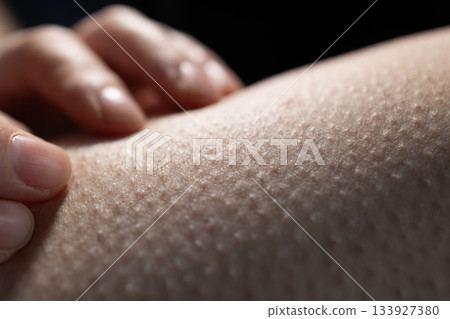 Skin Shows Goosebumps While a Hand Touches It During a Cool Moment in a Dim Setting Skin Shows Goosebumps While a Hand Touches It During a Cool Moment in a Dim Setting 133927380
