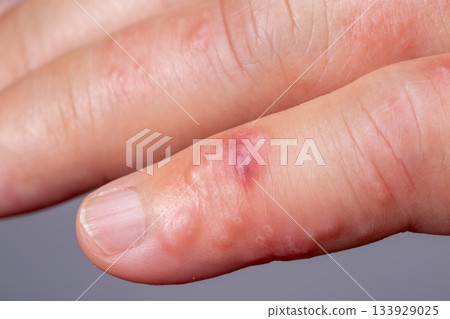 Shingles, Zoster or Herpes Zoster symptoms on arm. Shingles, Zoster or Herpes Zoster symptoms on arm. 133929025