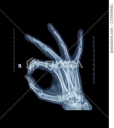 X-ray hand bones OK ring gesture joining the thumb and index finger in a circle 133938481