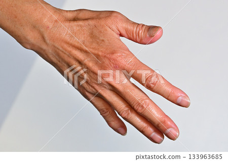 老人的右手:斑點和皺紋 老人的右手:斑點和皺紋 133963685
