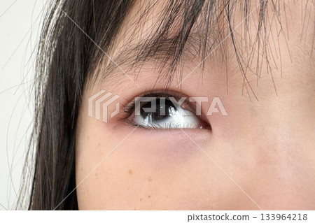 兒童麥粒腫 133964218