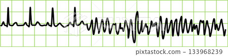 Ventricular fibrillation graphic material illustration Ventricular fibrillation graphic material illustration 133968239