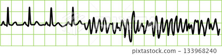 Ventricular fibrillation graphic material illustration 133968240
