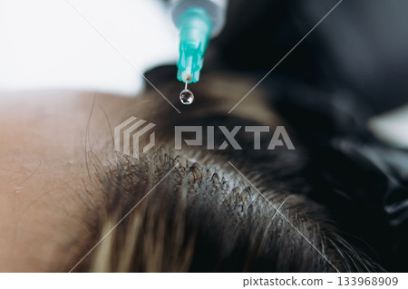 close up on woman head getting mesotherapy injections for stronger and healthier hair close up on woman head getting mesotherapy injections for stronger and healthier hair 133968909