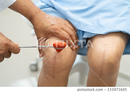 Doctor neurologist testing reflex knee with hammer and show Asian senior scars surgical total knee joint replacement. Doctor neurologist testing reflex knee with hammer and show Asian senior scars surgical total knee joint replacement. 133971685