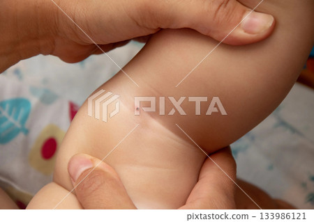Mite dug into the skin of a small child, the danger of the summer in the woods Mite dug into the skin of a small child, the danger of the summer in the woods 133986121