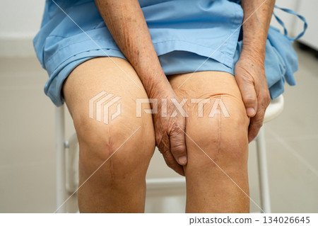 Asian elderly woman patient with scar knee replacement surgery in hospital. 134026645