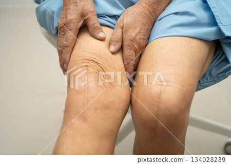 Asian elderly woman patient with scar knee replacement surgery in hospital. Asian elderly woman patient with scar knee replacement surgery in hospital. 134028289