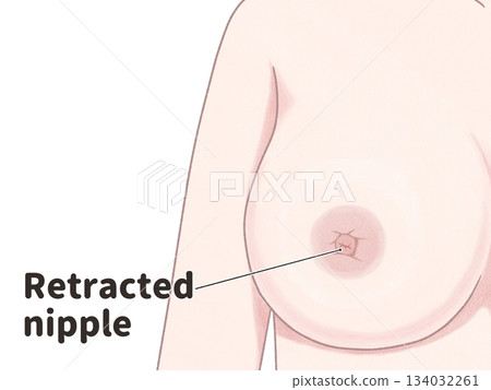 乳癌症狀:乳頭凹陷-簡潔易懂的英文插圖 乳癌症狀:乳頭凹陷-簡潔易懂的英文插圖 134032261