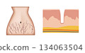 Woman abdomen showing stretch marks and detailed skin anatomy 134063504