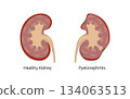 Healthy kidney and kidney with pyelonephritis, comparison and anatomy 134063513