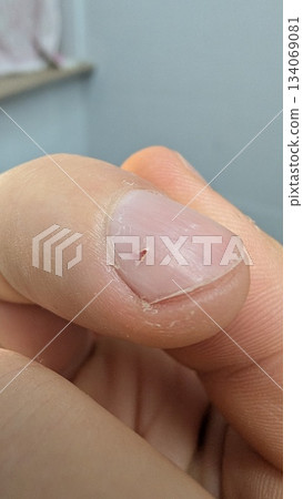 nail injury inspection, homeowner carefully assesses tiny wound under fingernail in daylight 134069081