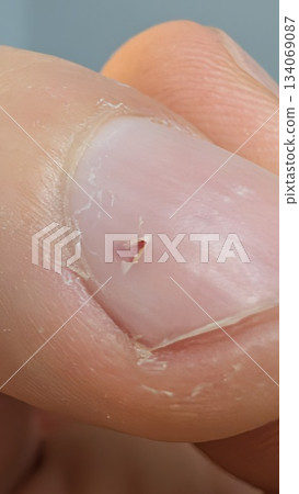 professional inspection reveals minor nail puncture with surrounding redness and sterile tools prepared 134069087