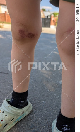 child injury detail, capturing childhood resilience through candid shot of scraped knees and sunlit child injury detail, capturing childhood resilience through candid shot of scraped knees and sunlit 134069619