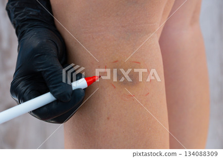 Doctor in medical gloves paint lines around bruise on her leg. Close up of stain bruise wound on leg. Healing injury hematoma blood consequences of sport activity trauma. Extravasation 134088309