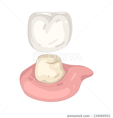 Illustration of crown prep 134089501