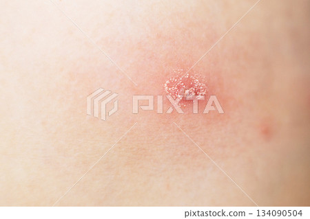 Human skin showing irritation, rash, and infection symptoms Human skin showing irritation, rash, and infection symptoms 134090504