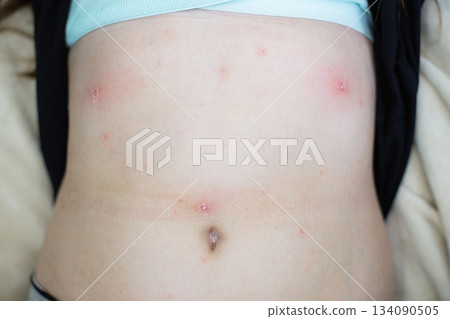 Body showing skin rash blisters chickenpox on stomach 134090505
