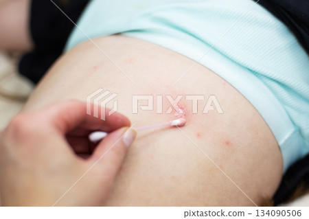 Parent applying cream to child's chickenpox rash Parent applying cream to child's chickenpox rash 134090506