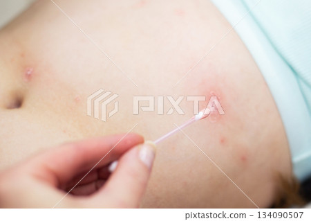 Parent applying cream to child's chickenpox rash Parent applying cream to child's chickenpox rash 134090507