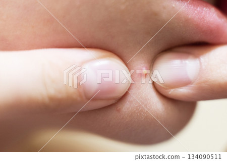 Fingers squeezing a whitehead pimple on skin Fingers squeezing a whitehead pimple on skin 134090511