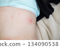 Body showing skin rash blisters chickenpox on stomach 134090538