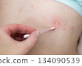 Parent applying cream to child's chickenpox rash 134090539