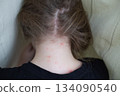 Child's neck with chickenpox showing skin rash and irritation 134090540