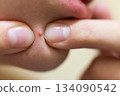 Fingers squeezing a whitehead pimple on skin 134090542
