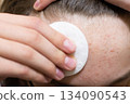 Forehead skin cleansing with cotton pad removing acne 134090543