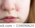 Child having impetigo skin infection chicken pox on face 134090620